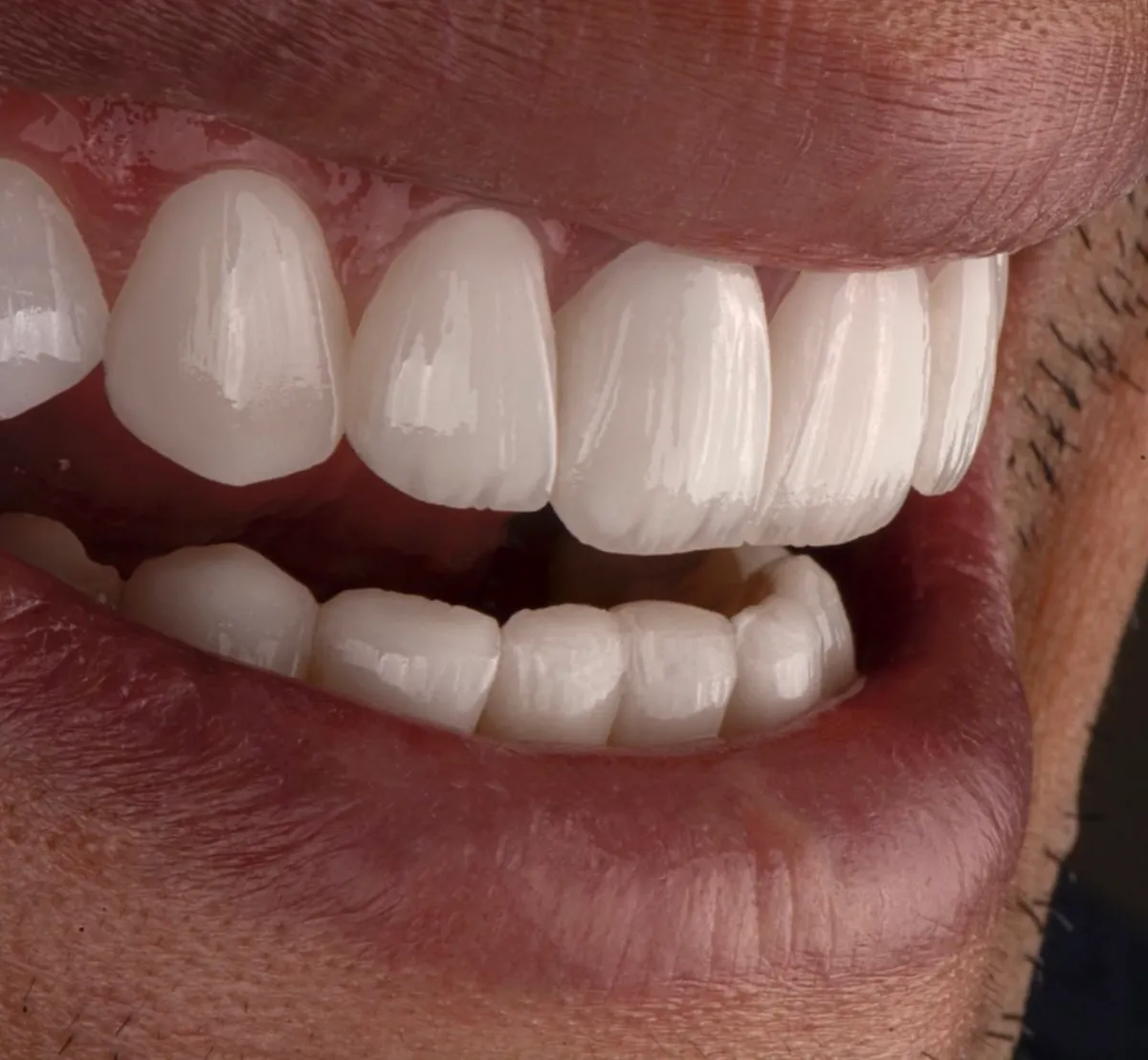 Close-up of upper and lower porcelain veneers in a natural, balanced smile